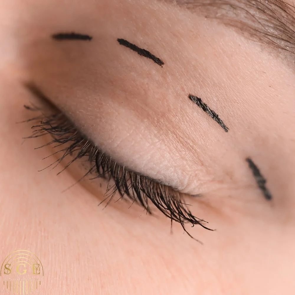 Göz Kapağı Estetiği Nedir